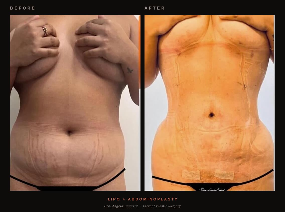 Before & After — Lipo + Abdominoplasty