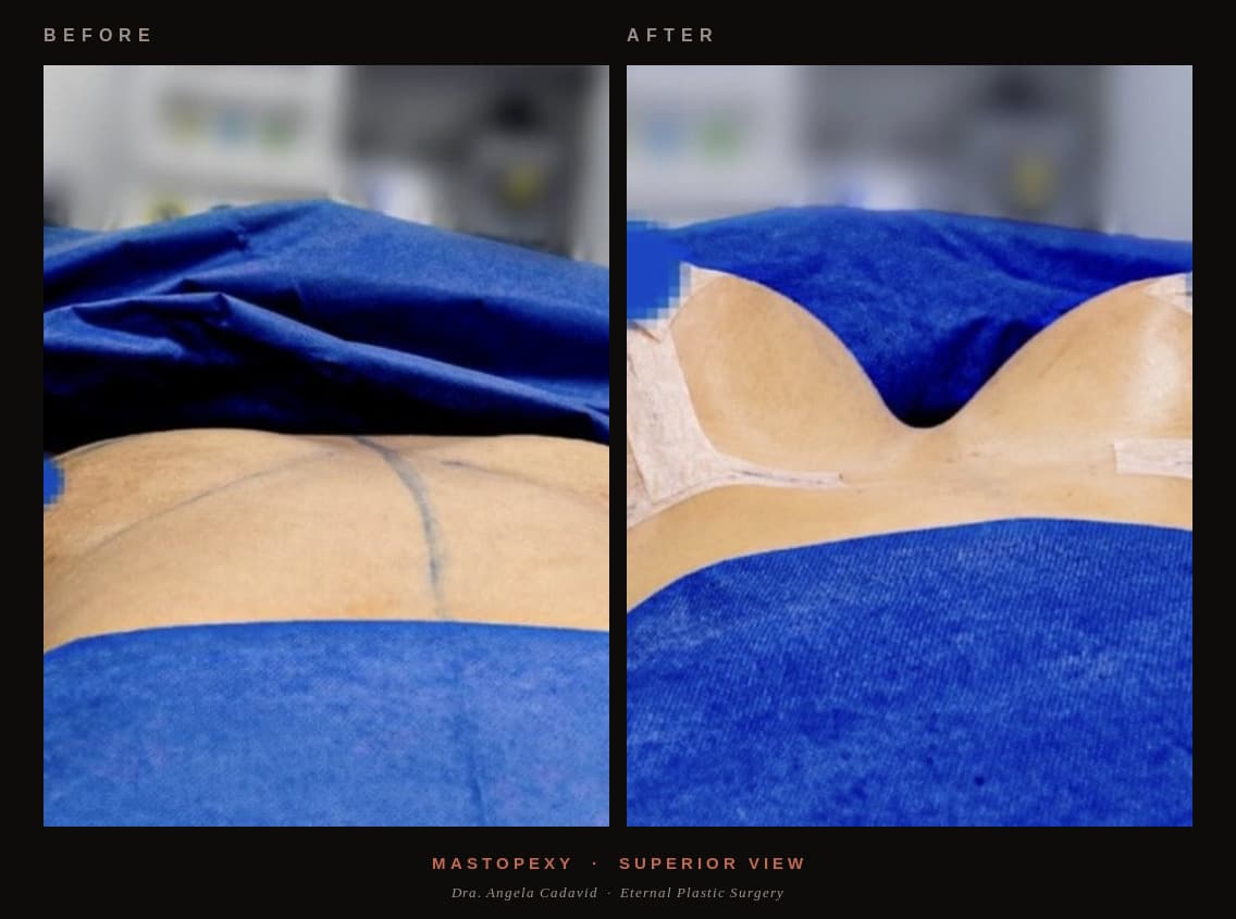 Before & After — Mastopexy — Before & After