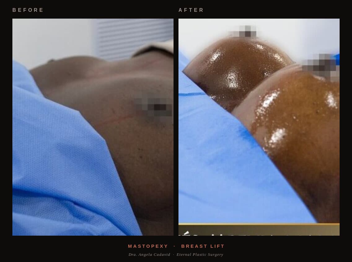 Before & After — Mastopexy (Breast Lift)