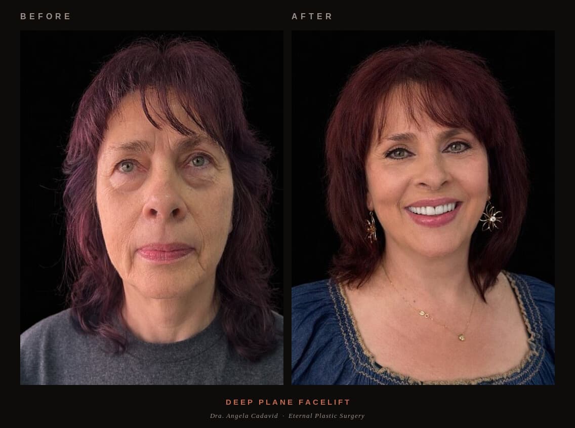 Before & After — Deep Plane Facelift